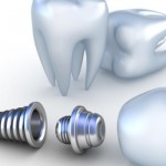Replace A Tooth