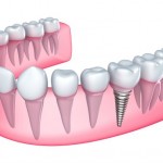 Dental implant services